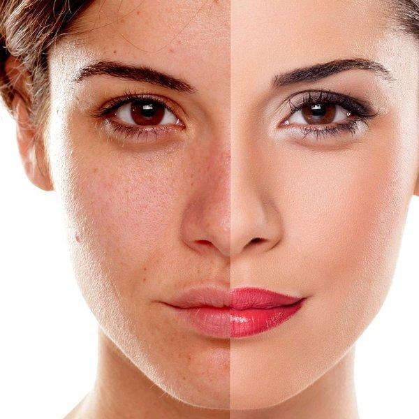 Hyperpigmentation Treatment Dubai: Best Procedures, Clinics & Cost Guide