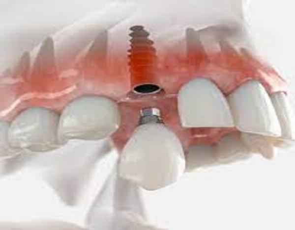 Complete Guide to Teeth Crowns in Dubai: Types, Costs and Clinic Tips