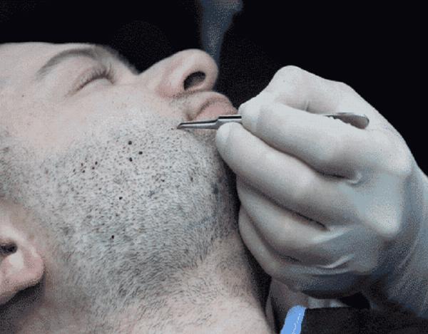 Beard Transplant in Dubai: Techniques, Costs, and Clinic Guidance