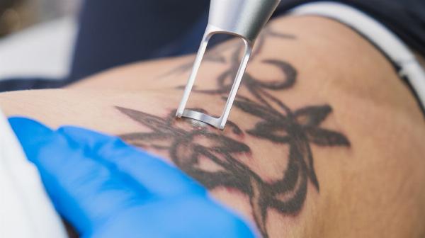 Laser Tattoo Removal in Dubai: A Practical Guide to Safety, Cost, and Results