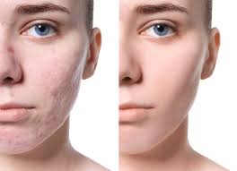 The Ultimate Guide to eMatrix Treatment in Riyadh
