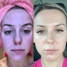 Red Light Therapy Before and After: Timeline, Real Results, and What to Expect