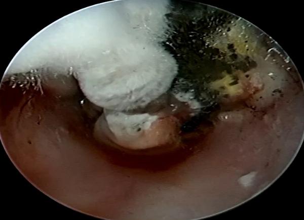 Complete Otomycosis Treatment Guide: Manage Fungal Ear Infections Effectively