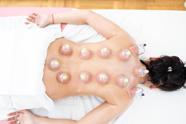 Cupping Therapy in Riyadh: Safe Practices, Benefits, and What to Expect