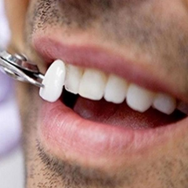 E-max Veneers in Dubai: Cost, Procedure, Results and Choosing a Clinic