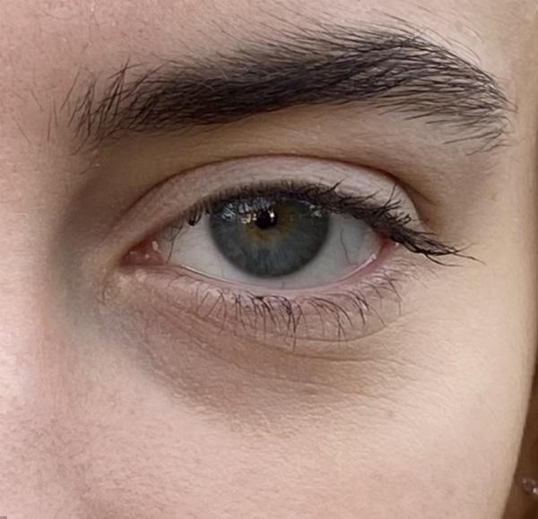 Effective Milia Treatments: A Practical Guide for Brighter, Clearer Skin