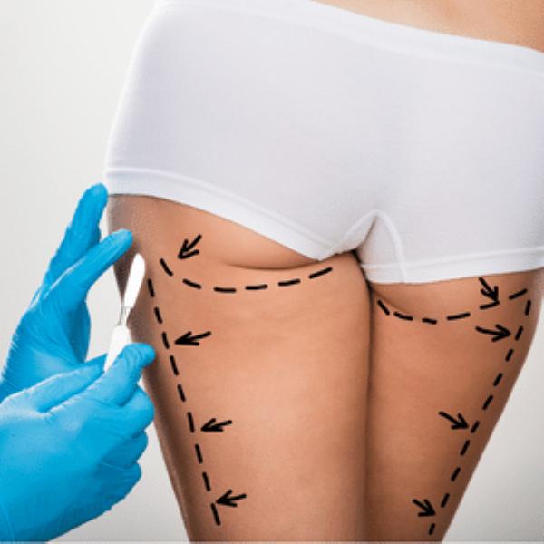 Navigating the Costs of Liposuction in Riyadh: A Comprehensive Overview