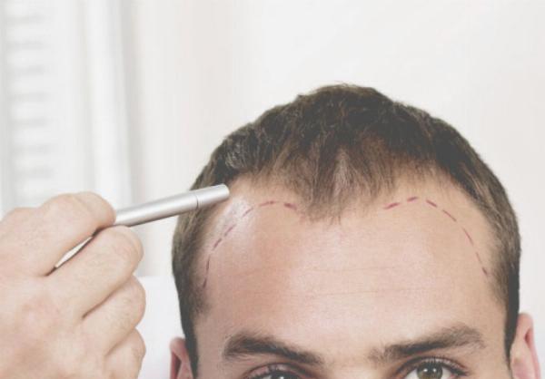 FUE vs FUT Hair Transplant: Compare Techniques, Recovery, and Scarring