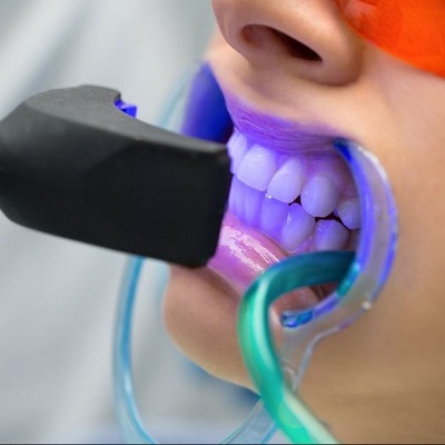 Home Teeth Whitening in Dubai: Practical Best Practices for Special Occasions
