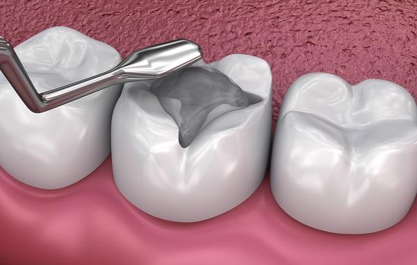 Dental Fillings Cost in Riyadh: Compare Prices, Materials, and Affordable Options