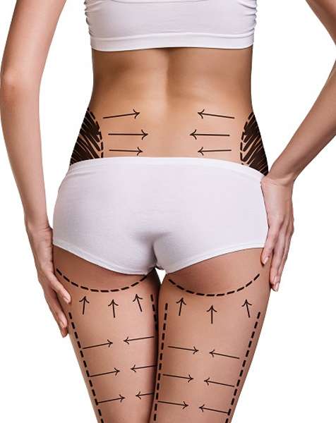 Liposuction Cost in Riyadh: Complete Guide to Prices, Fees, and What to Expect