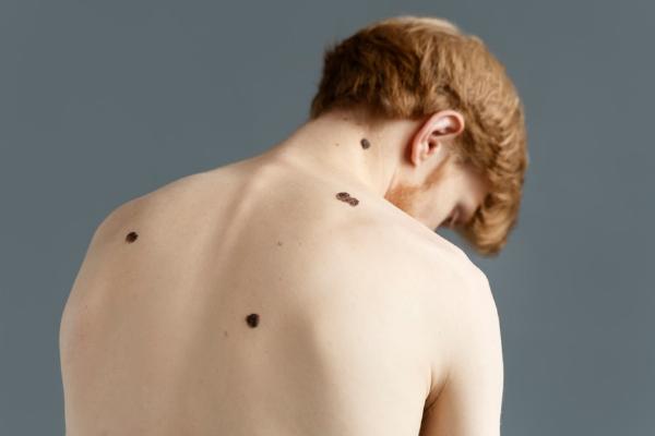 Safe Quick Skin Tag Removal: Natural Healing Steps and Checklist