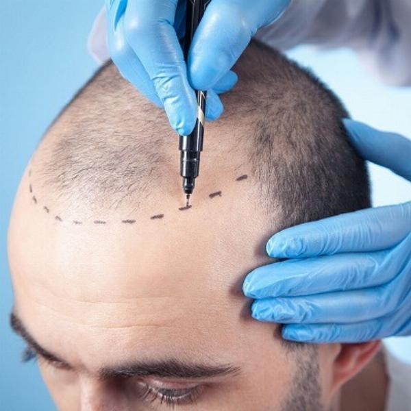 Is Front Line Hair Fixing in Dubai Right for You? Practical Guide to Suitability, Cost, and Risks