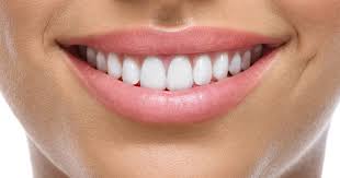 E-Max Veneers in Riyadh: A Practical Guide to Durable, Natural-Looking Smiles