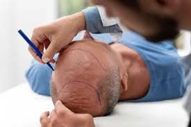 Hair Transplant Costs in Riyadh: Real Prices, What Drives Them, and How to Budget