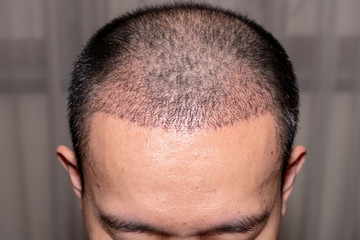Islamic Ruling on Hair Transplants: Is Hair Transplant Haram in Islam?