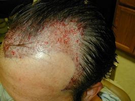 Finasteride for Hair Loss: Practical Guide to Use, Safety, and Results