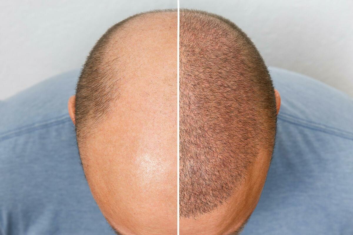Why Riyadh is Leading in GFC Hair Treatments