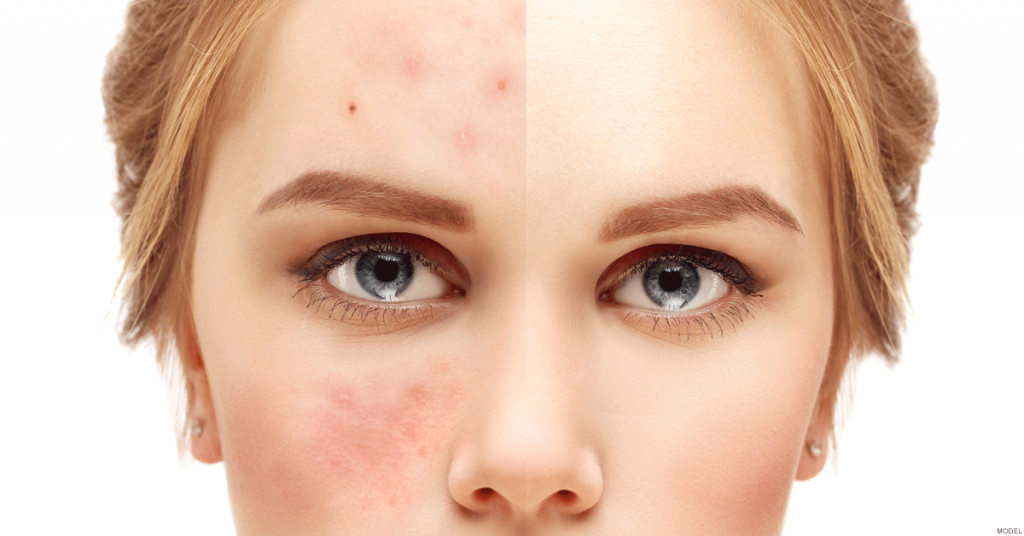 Best Clinics in Dubai for Acne and Oily Skin Treatments