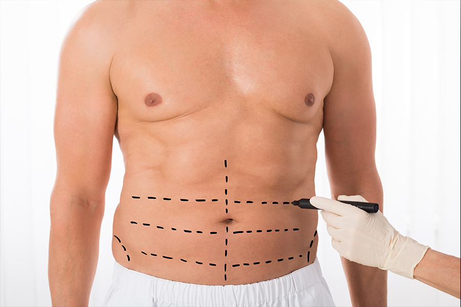 Popular Areas for Liposuction Surgery in Riyadh: Abdomen, Thighs, and More