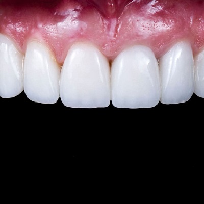 Maintaining Your E-max Veneers in Dubai&rsquo;s Climate: Tips and Tricks