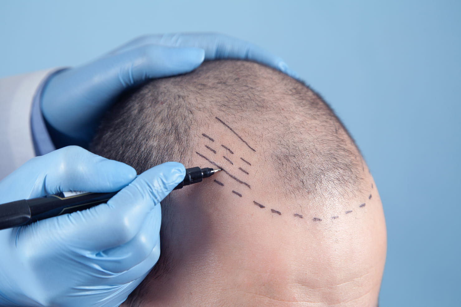 Hair Transplant Cost and Financing Options in Riyadh