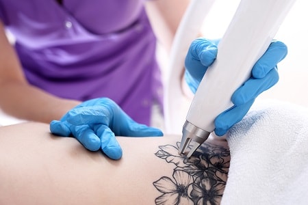 How Picosure Tattoo Removal Works on Difficult-to-remove Tattoos in Dubai