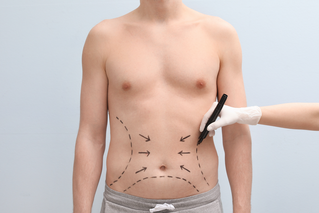 VASER Liposuction Recovery Tips: What to Expect in Riyadh