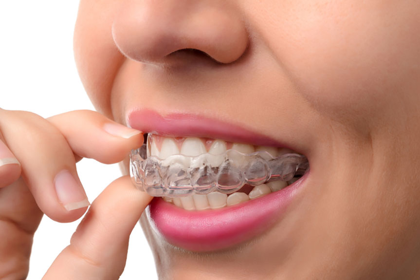 Hidden Fees You Should Know About Invisalign Braces in Dubai