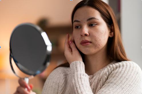 Say Goodbye to Acne Scars: Exploring the Best Acne Treatments in Dubai