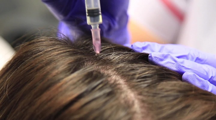 What Are the Costs Associated with PRP Hair Treatment?
