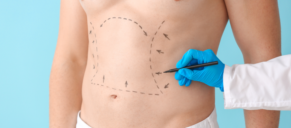 Liposuction Surgery FAQs: Riyadh Edition