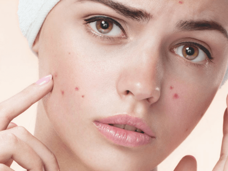 Say Goodbye to Pimples with Riyadh&rsquo;s Top Skin Clinics