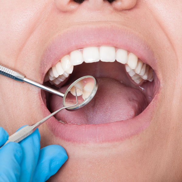 Is Tooth Extraction in Dubai Worth the Price? A Cost Breakdown