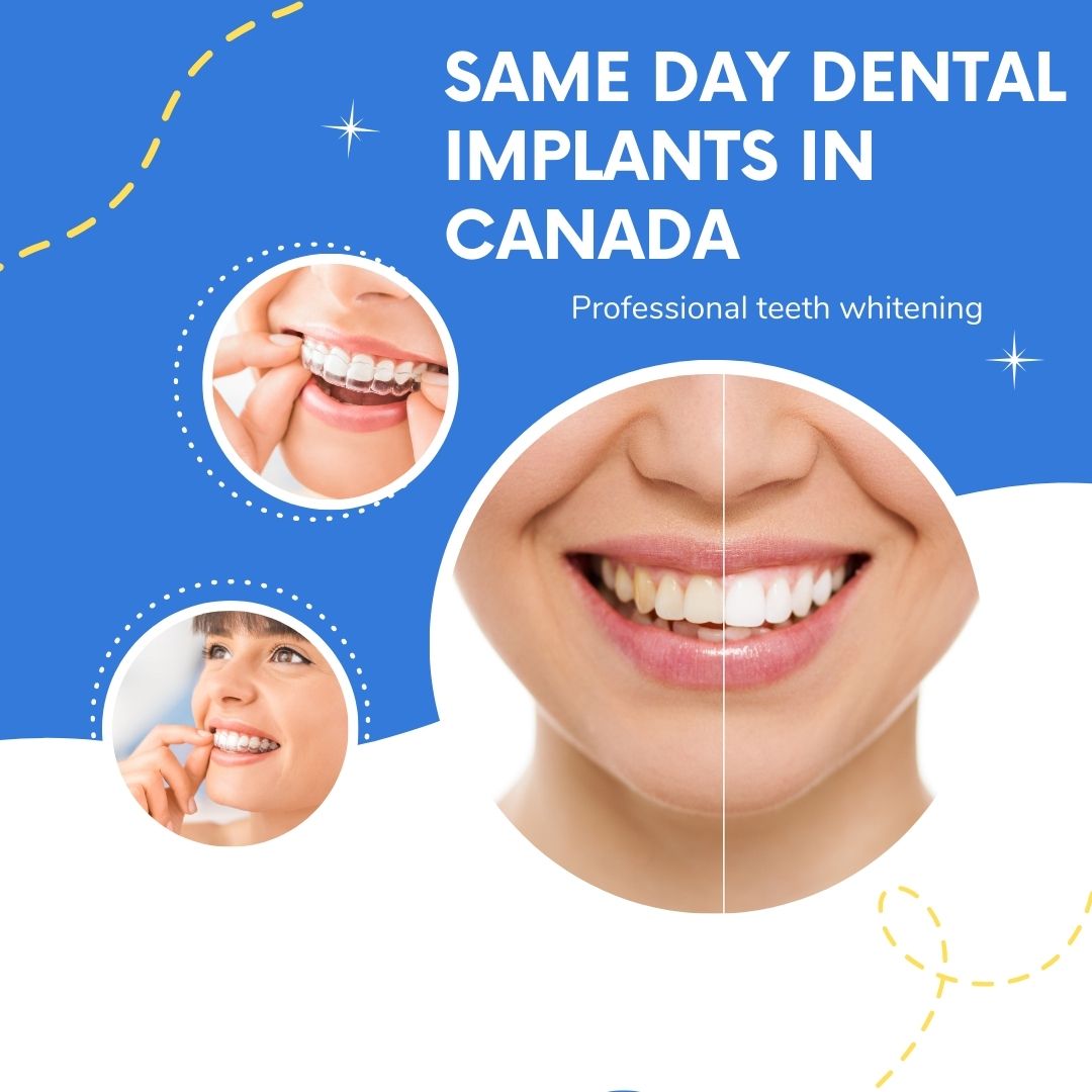 Same Day Dental Implants in Canada