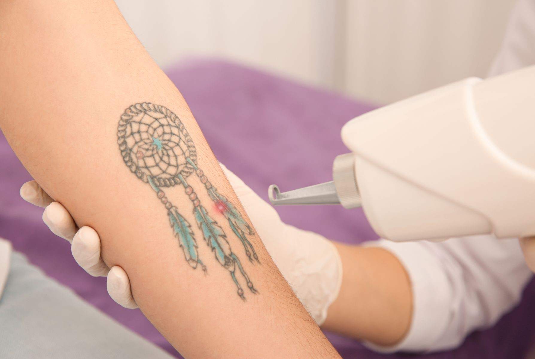 Is Laser Tattoo Removal Right for You? A Dubai Expert&rsquo;s Guide