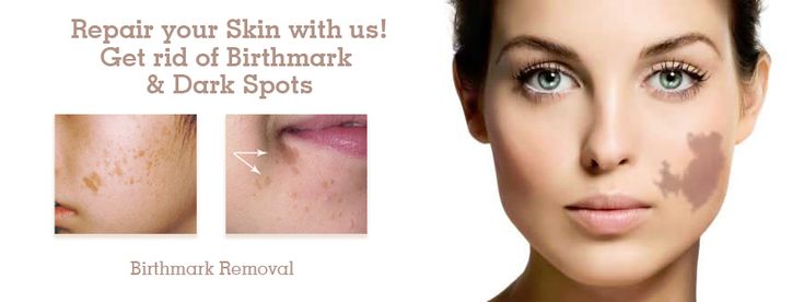 Understanding Birthmark Removal Techniques in Riyadh