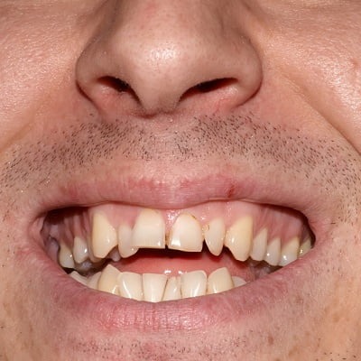 How to Achieve a Perfect Smile with Overlapping Teeth Treatment in Dubai