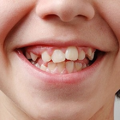 The Latest Trends in Overlapping Teeth Treatment in Dubai