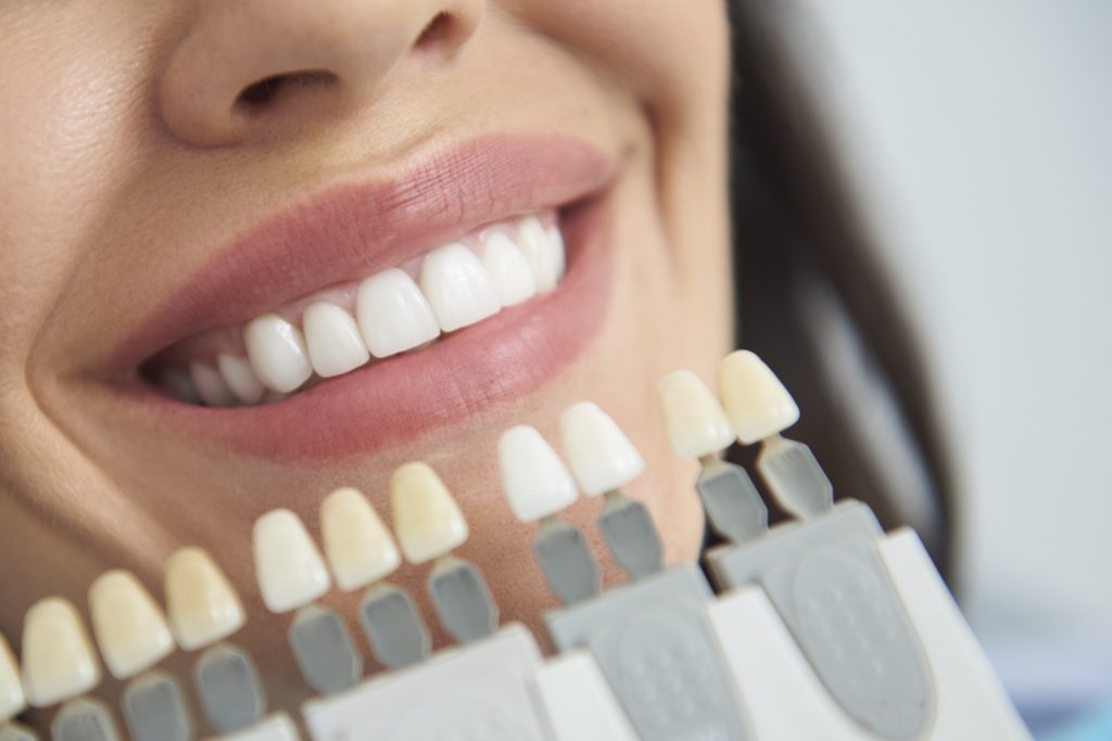 Elevate Your Dental Aesthetics with Composite Veneers in Dubai