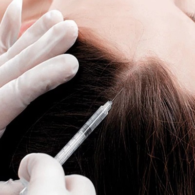Dubai&rsquo;s Experts in Exosome-Based Hair Growth