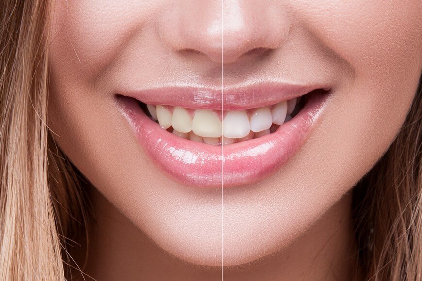 Discover Top Teeth Whitening Solutions Offered in Dubai