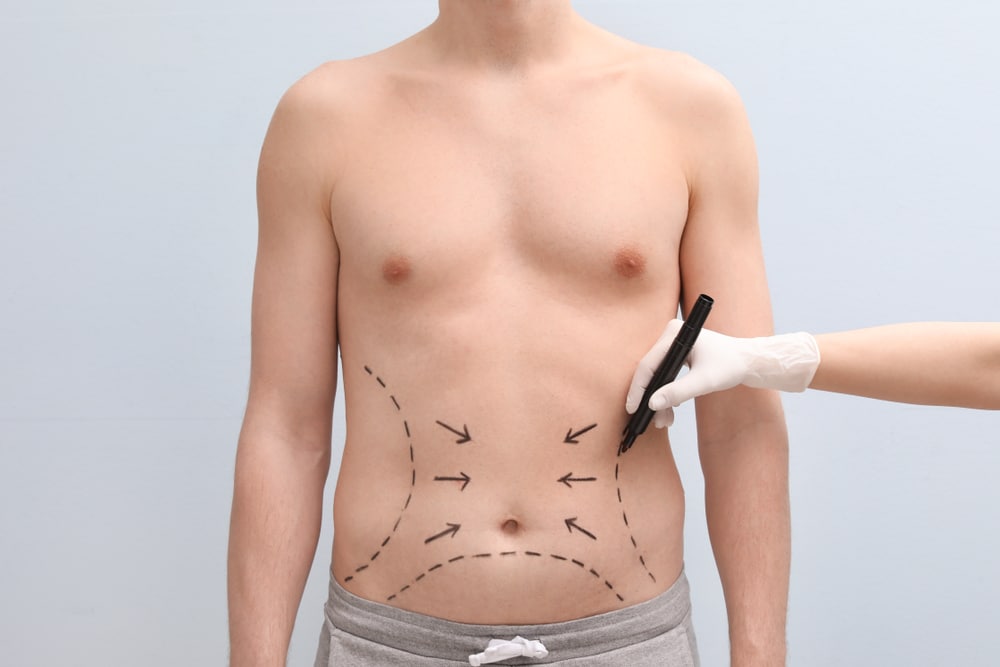 Innovative Liposuction Surgery Techniques Used by Riyadh Surgeons
