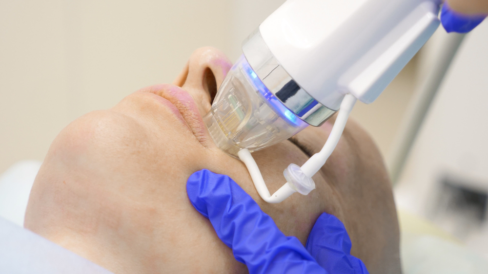 Fractional RF Microneedling: How It Works for Dubai&rsquo;s Skin Needs