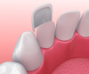 Ultra Thin Dental Veneers: A Smile Makeover in Dubai