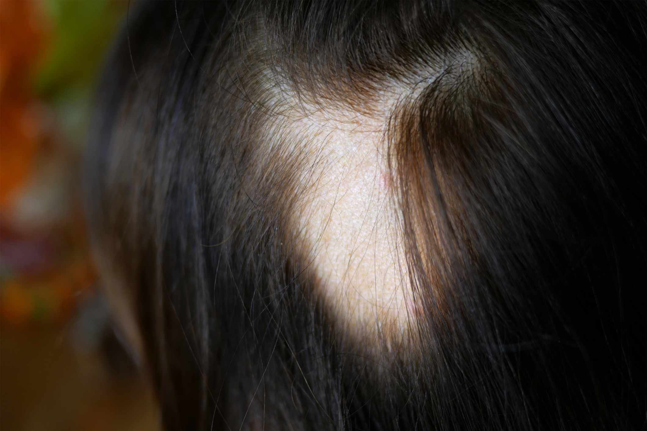 Finasteride: What Makes It Work for Hair Loss?