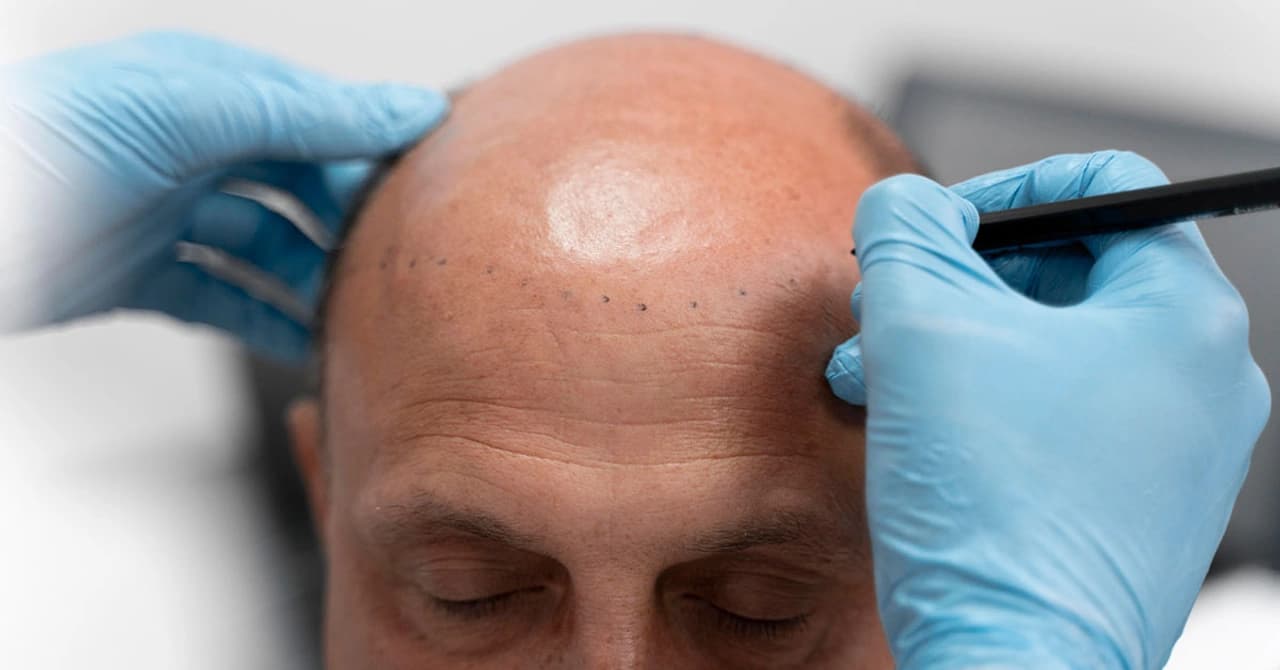Can I Go Bald Again After A Hair Transplant?