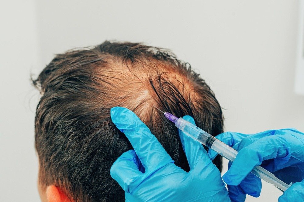 Can a Hair Transplant Prevent Baldness?