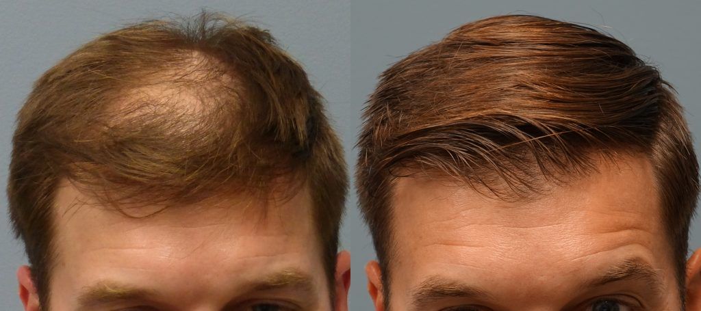 Hair Transplant in Dubai: Real Patient Reviews