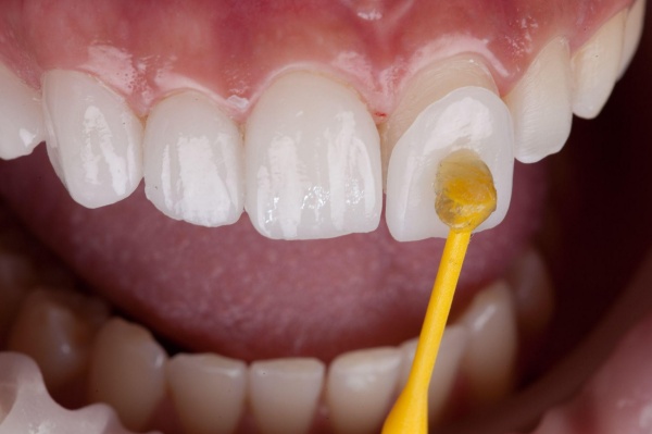 Răng mẻ c&oacute; tr&aacute;m được kh&ocirc;ng? Giải đ&aacute;p từ chuy&ecirc;n gia